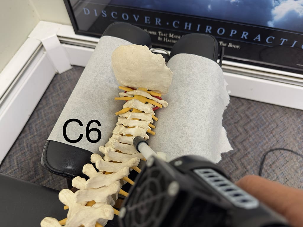 Placement for a C6 vertebral adjustment to free the C6 nerve.