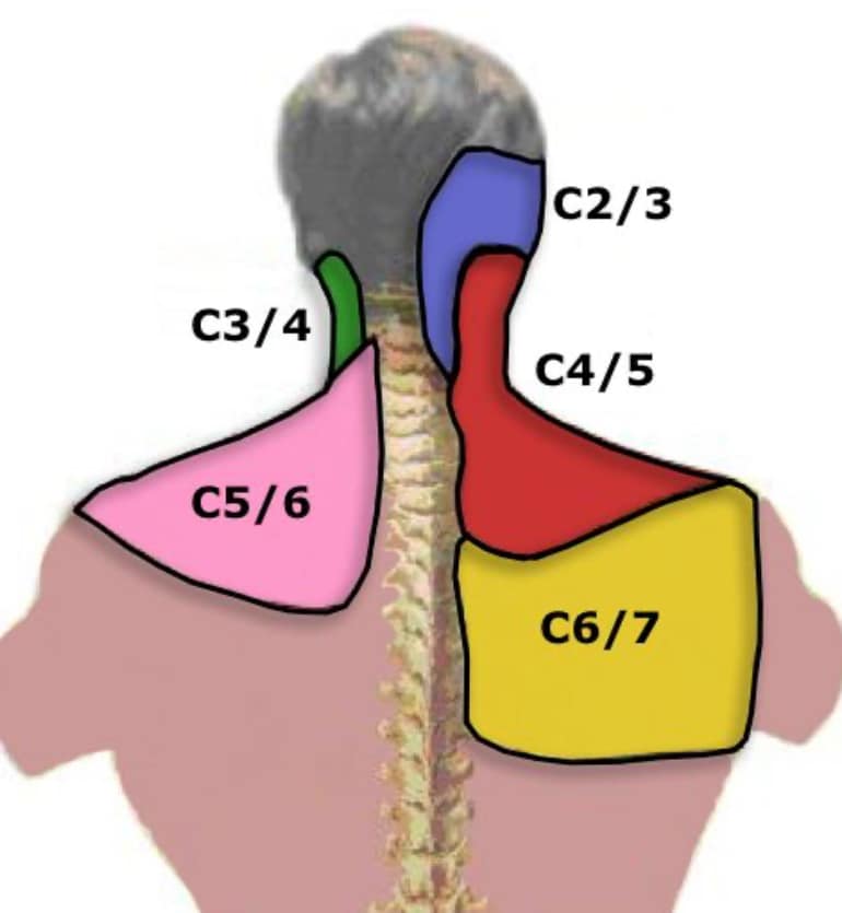 C5 nerve muscle innervation and Neck Pain