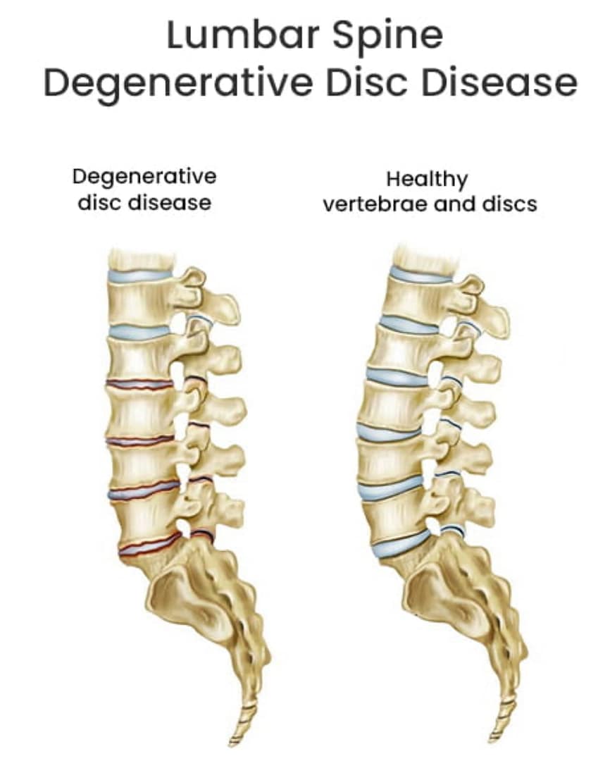 Chiropractic care to keep a spine healthy